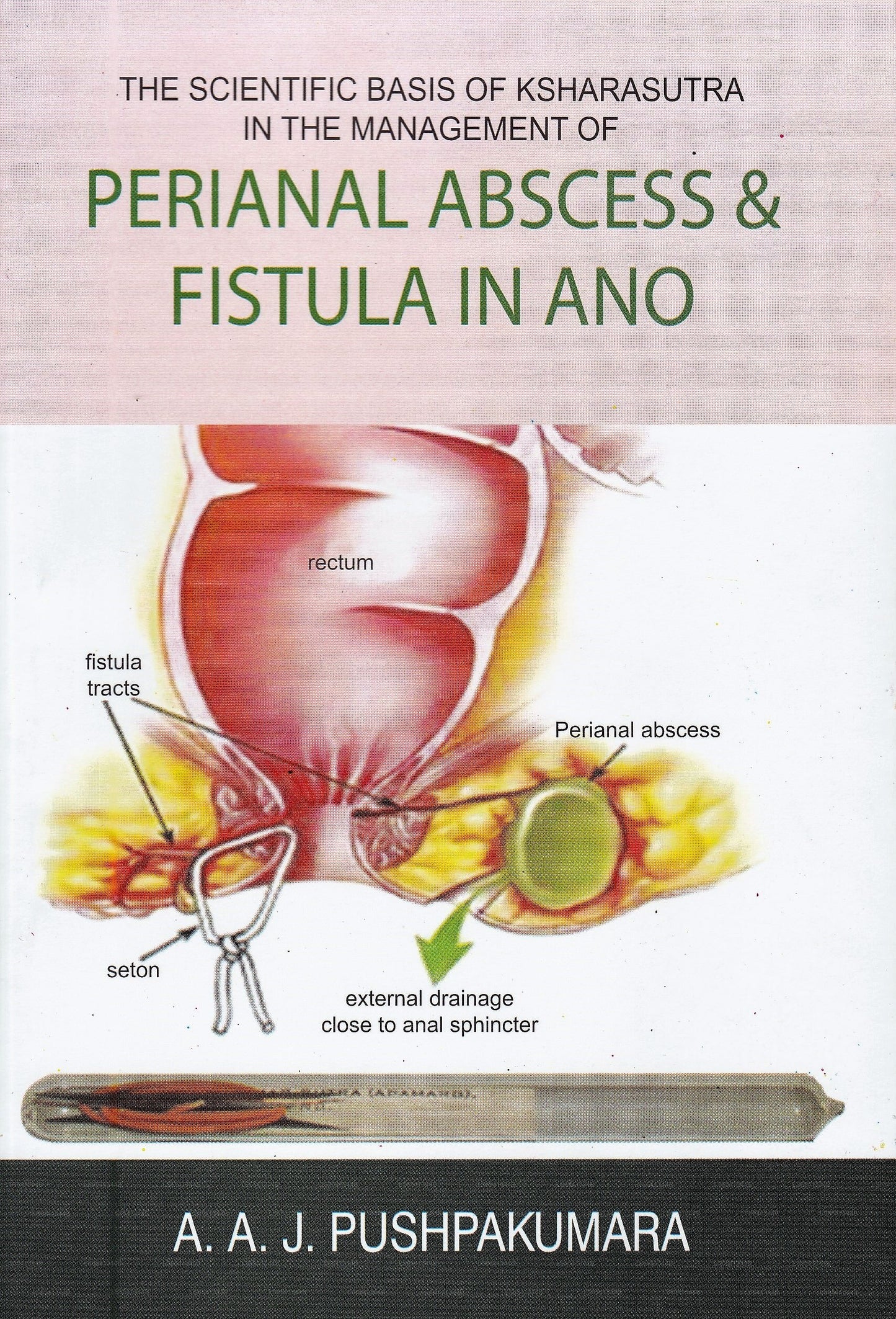 The Scientific Basis of Ksharasutra In The Managment of Perianal Abscess &Amp; Fistula In Ano